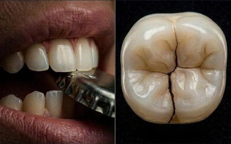 Sang chấn gây nứt dọc thân răng – tổn thương âm thầm nhưng có thể khiến mất răng nếu phát hiện quá muộn
